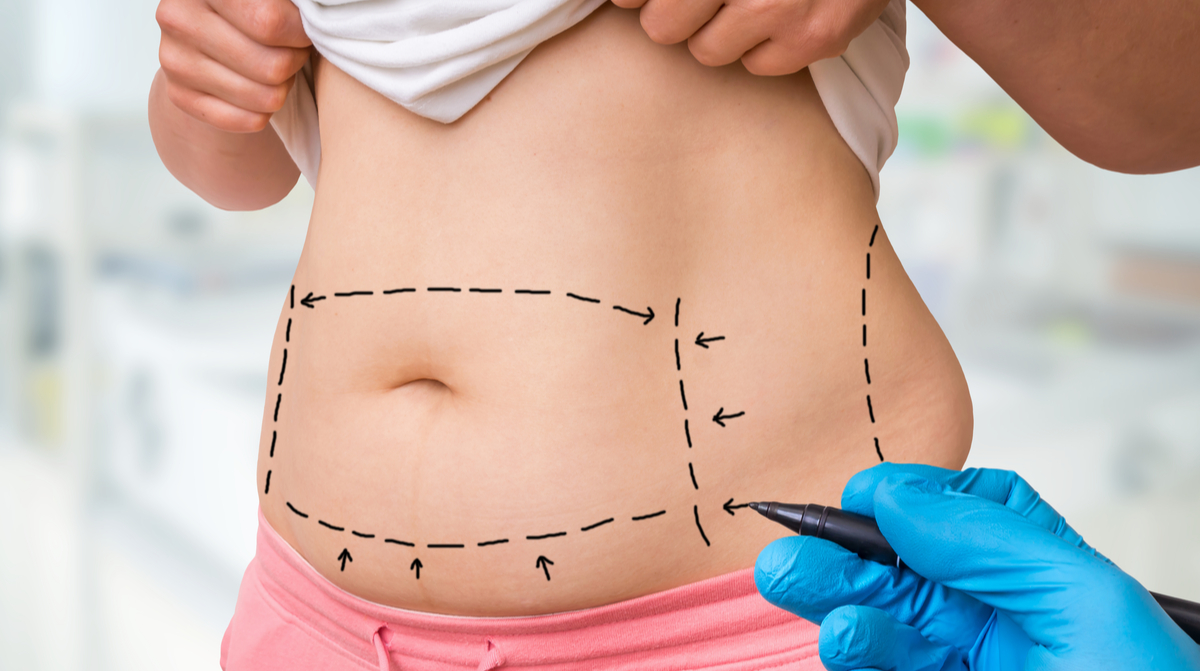 liposuction